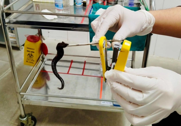 Đỉa dài 10 cm sống ký sinh trong mũi người bệnh